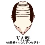 VA型