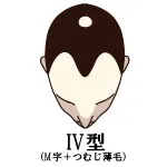 IV型