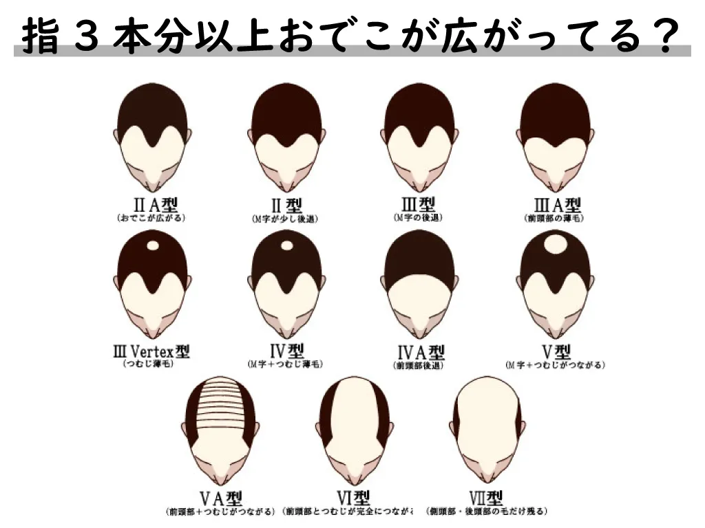 指3本分以上おでこが広がってる?