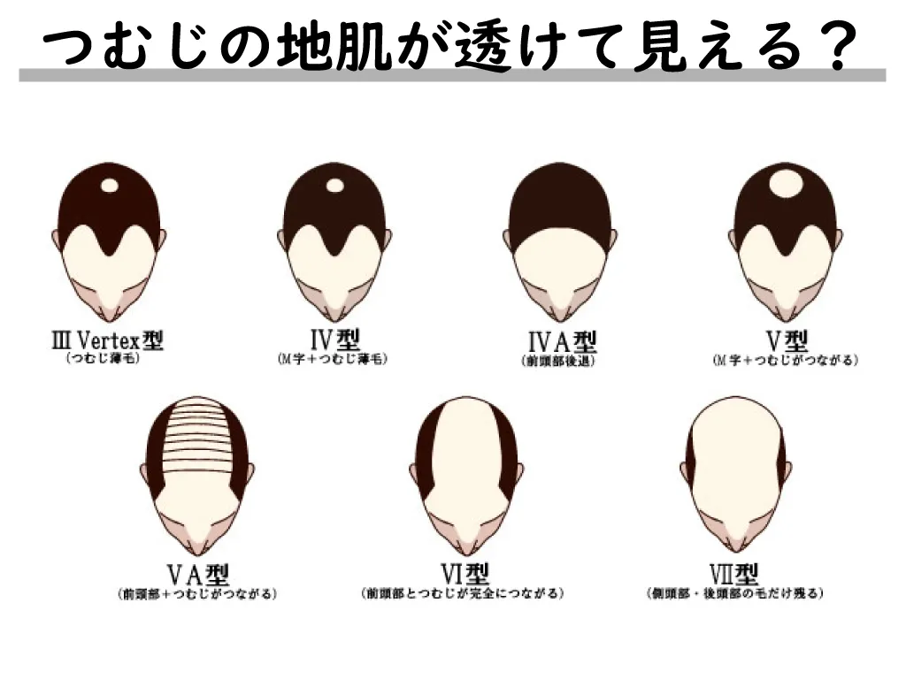 つむじの地肌が透けて見える