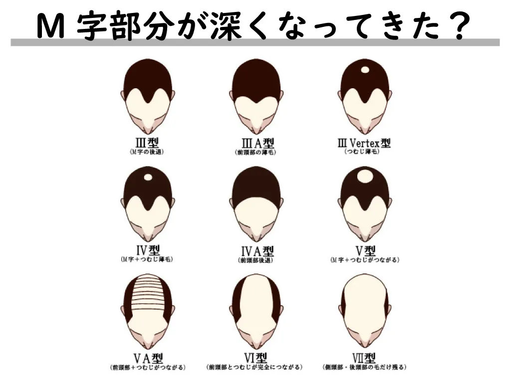 M字部分が深くなってきた