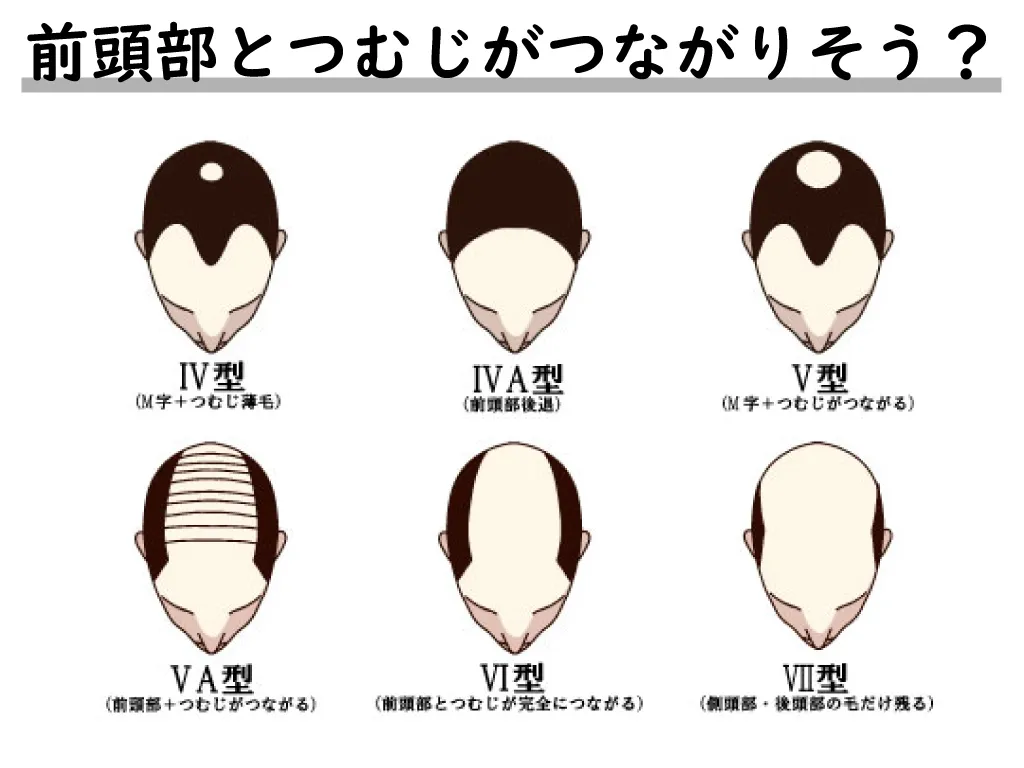 前頭部とつむじがつながりそうな状態